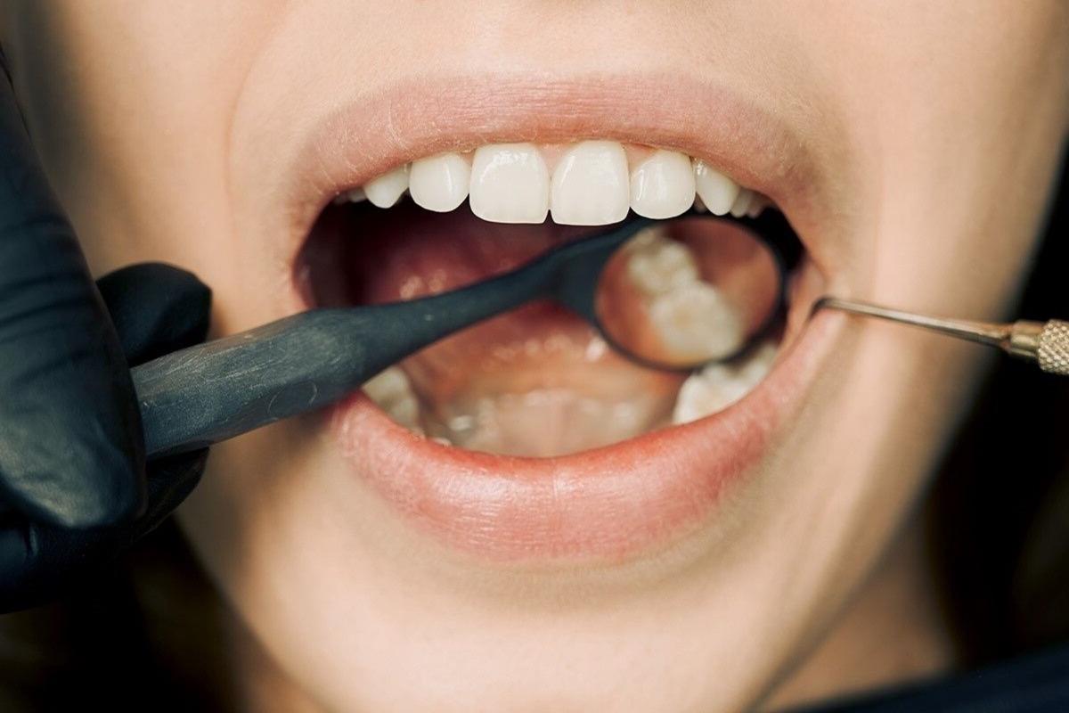 dental implants in Brentwood