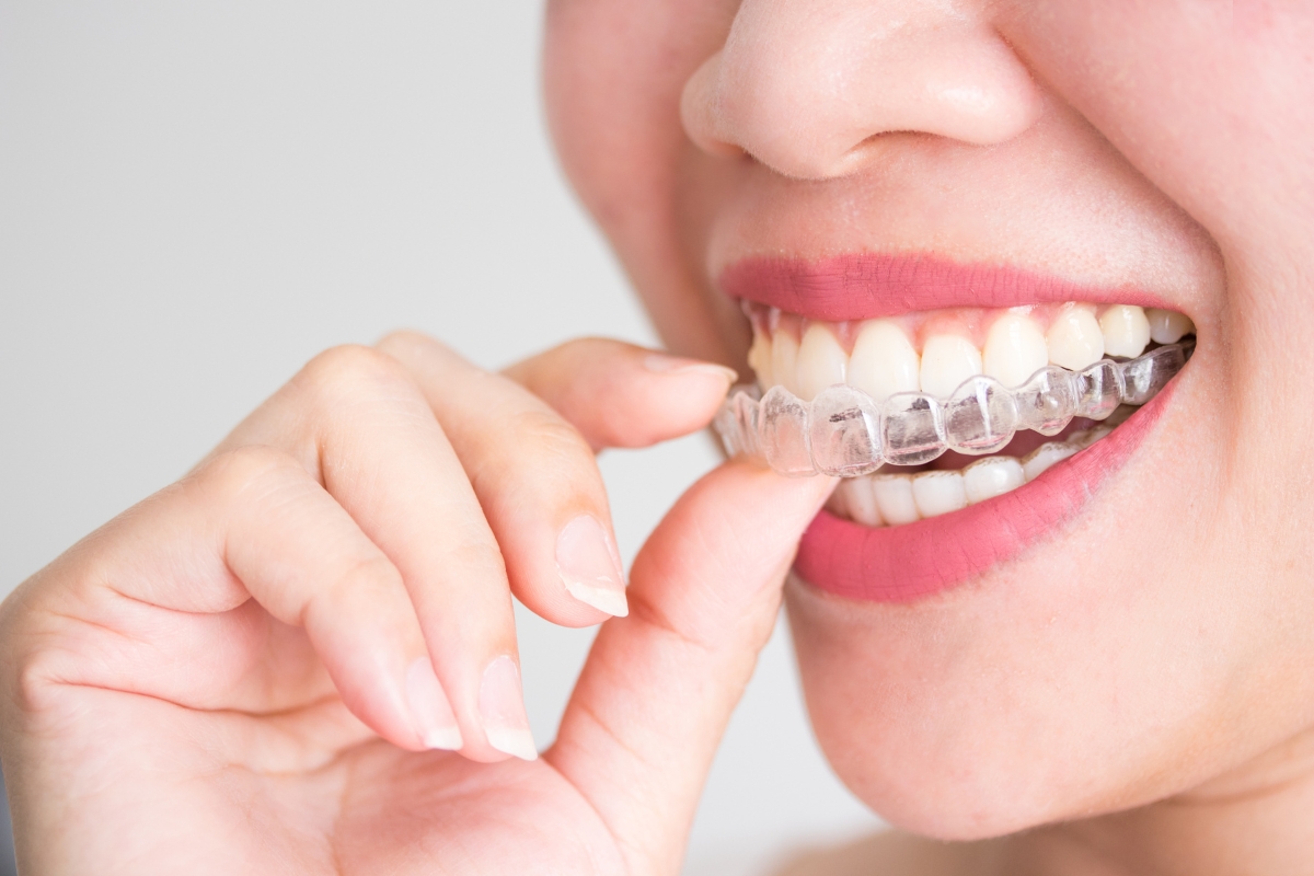 Invisalign Treatment Lewisburg TN