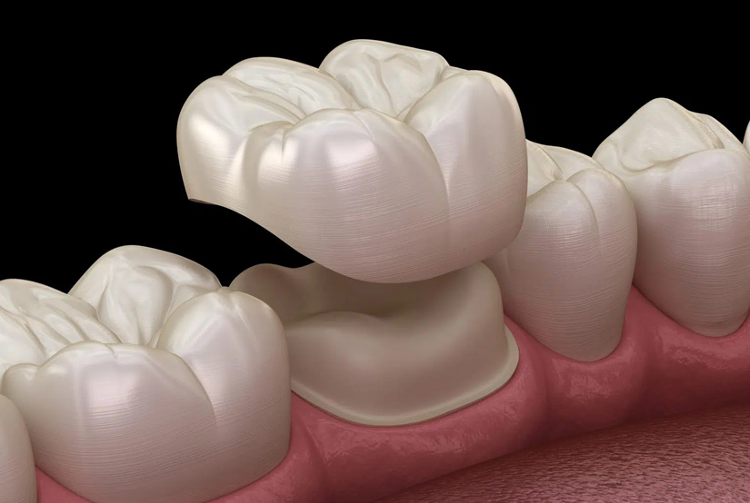 Hsllmark Dental Brentwood offers Cosmetic Dental Crowns in Brentwood TN