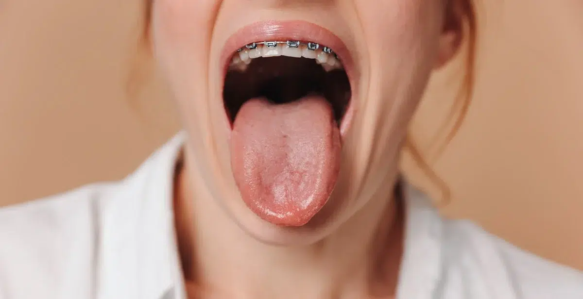 Woman with dry mouth