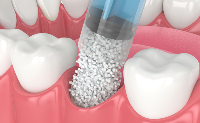 Dental bone grafting procedure restoring jawbone for a future dental implant in Austin, TX