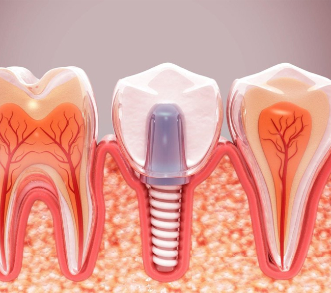 Illustration showing a dental implant replacing a missing tooth in the jawbone in Austin, TX