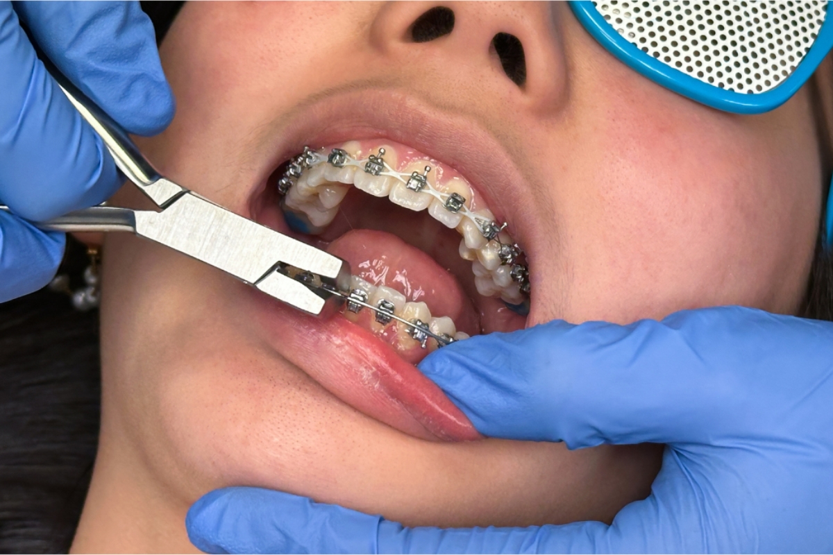 Braces Franklin