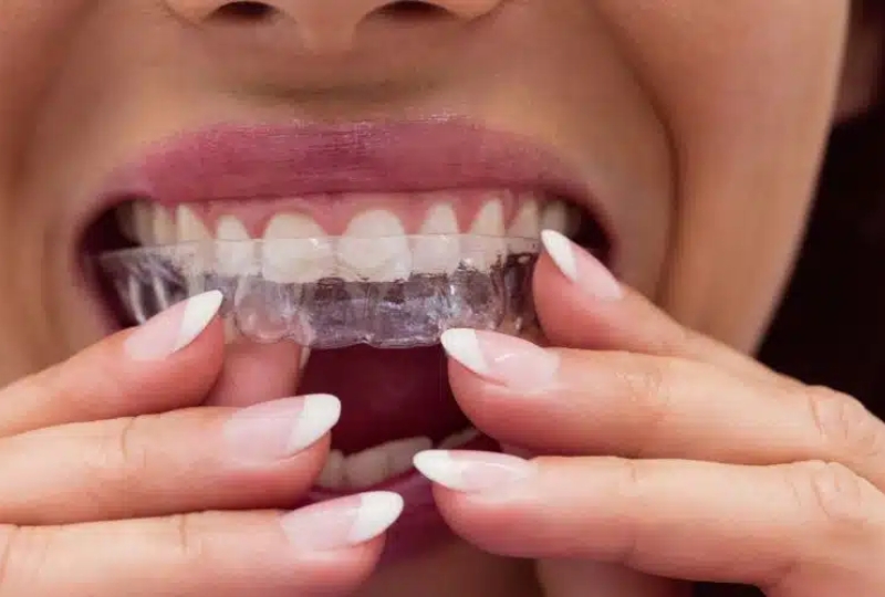 Featured image for “The Benefits of Choosing Invisalign Treatment in Havertown, PA”