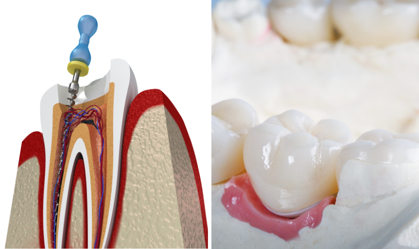 Featured image for “Can You Get A Root Canal And Crown On The Same Day?”