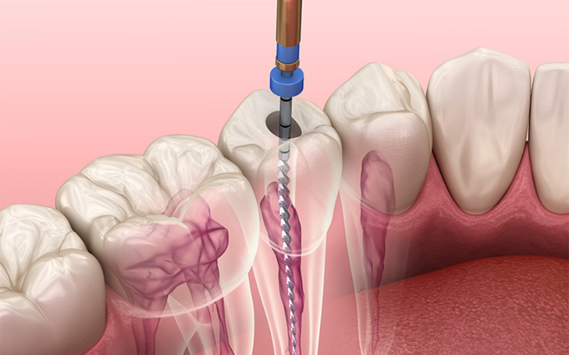 Featured image for “Root Canal Red Flags: How Poor Oral Habits Can Sabotage Your Recovery”