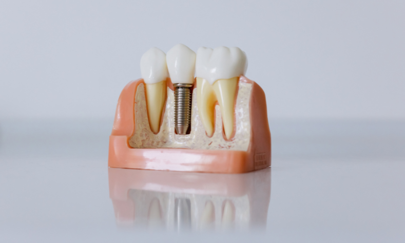 Featured image for “How To Care For Your Dental Implants: Top Five Tips For Long-Life”