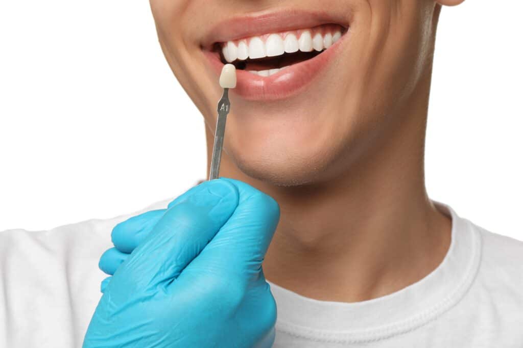 Dental Veneers Columbia
