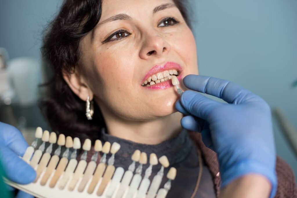 Veneers in Columbia