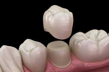 porcelain dental crowns