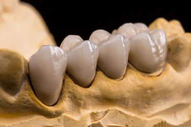 same-day temporary dental crowns