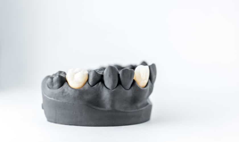 Can a Dental Bridge be Done in One Day