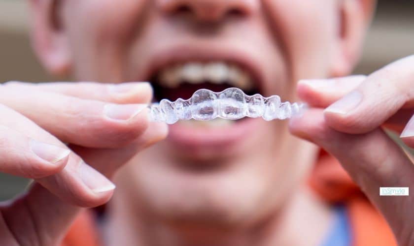 invisible braces