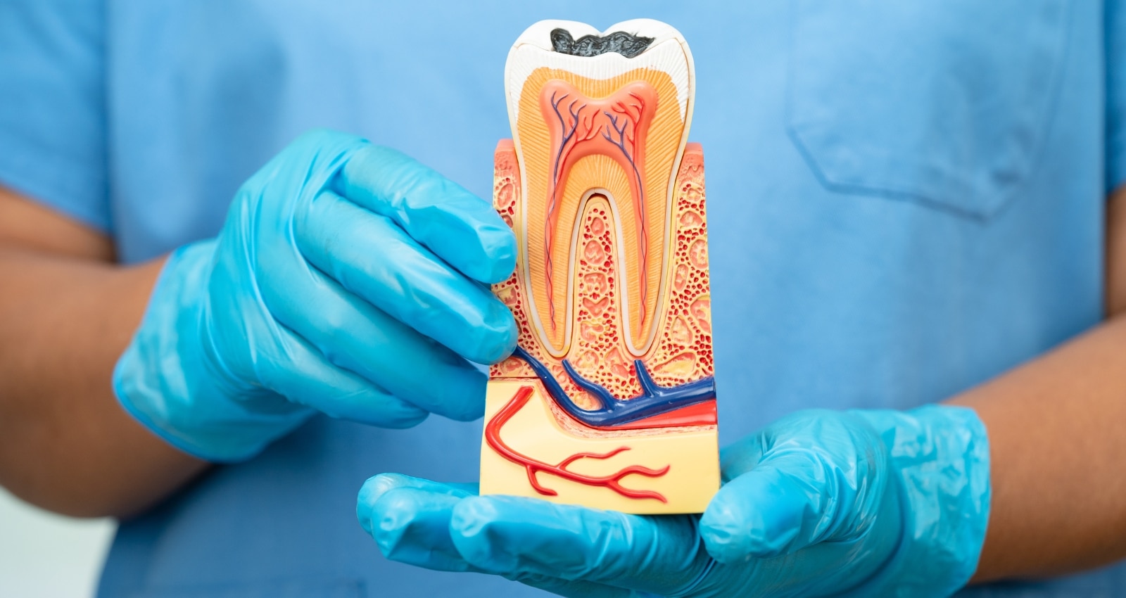 a dentist of In Smyle Dental holding root canals module in Chicago IL