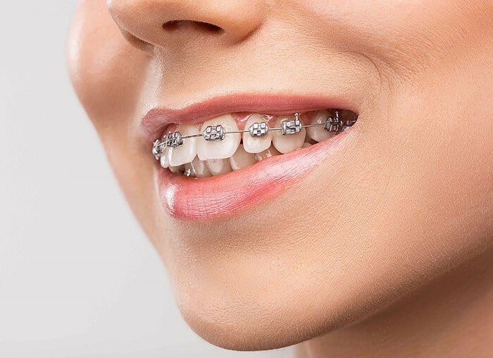 clear braces chicago
