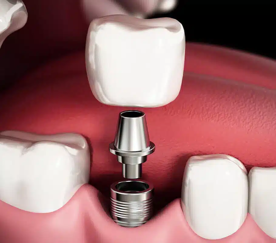 dental implants chicago il