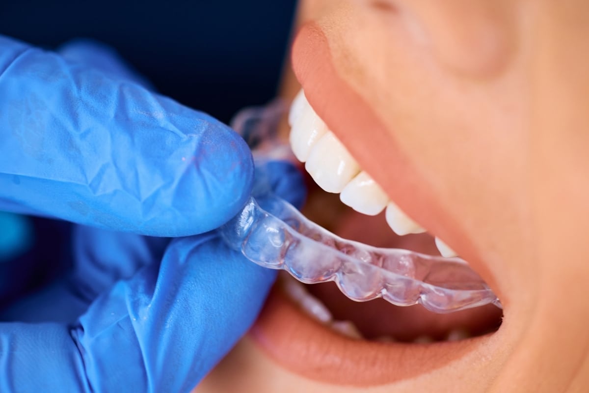 Invisalign-Dentist-Lakeview-and-Roscoe-Village
