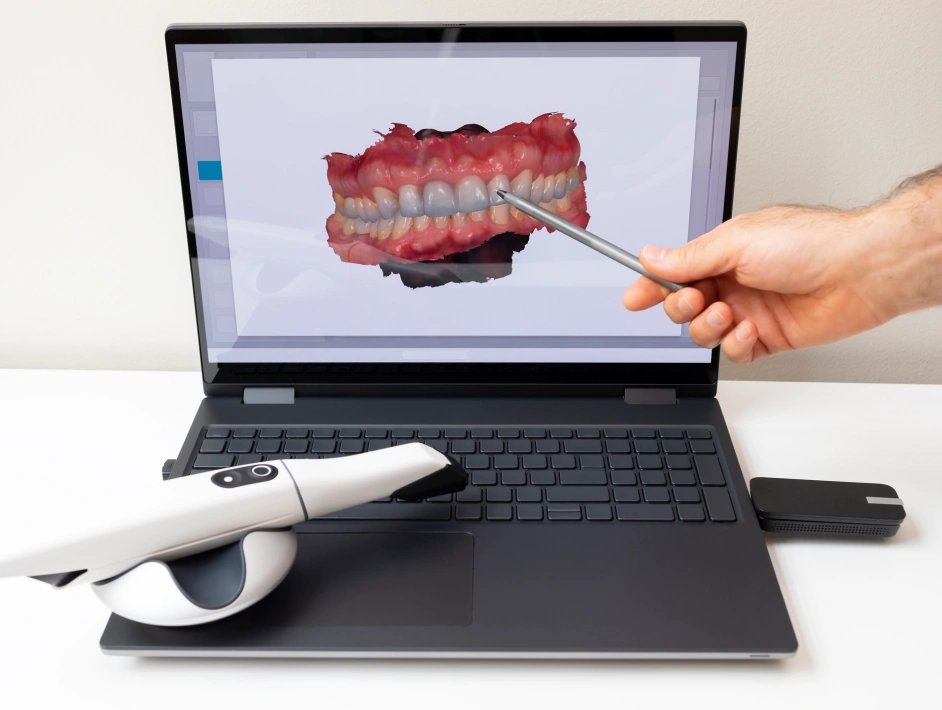 Intraoral Scanner Image