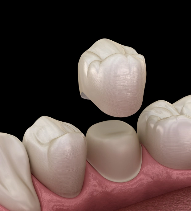 img-dental-crowns