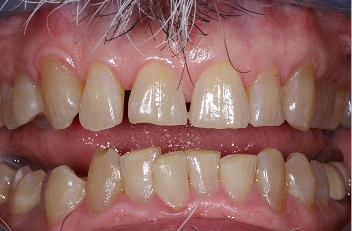 Dental Cleanings Iowa City | The Dental Lounge
