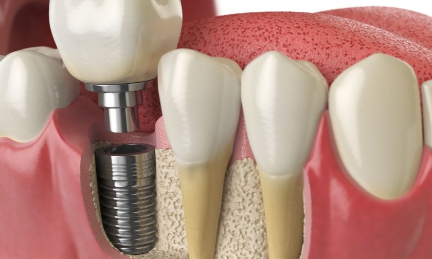 Can You Actually Grow Allergic to Your Own Smile? The Dental Lounge Explains the Difference between Titanium and Zirconia