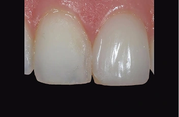 Oral Cancer Screening in Coralville: Comparing Your Detection Options