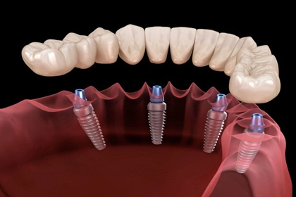 all-on-4 dental implants Irvine