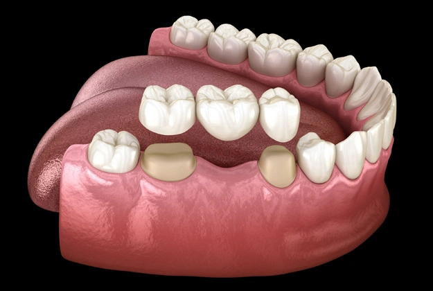 Dental Bridges Irvine