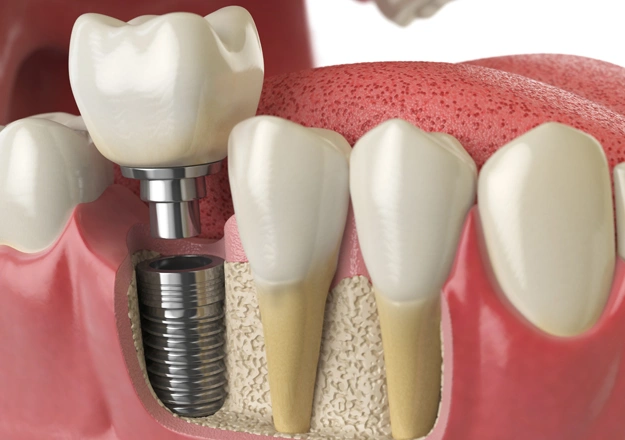 implant restorations irvine