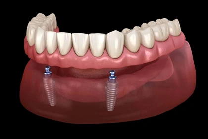 implant retained denture Irvine