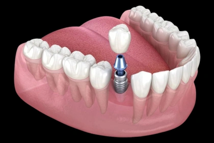 single dental implant Irvine