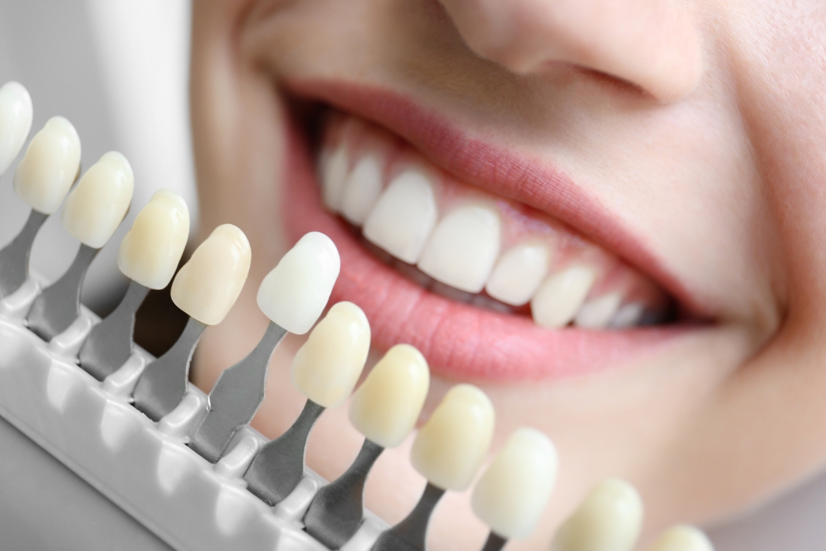 teeth whitening in Irvine