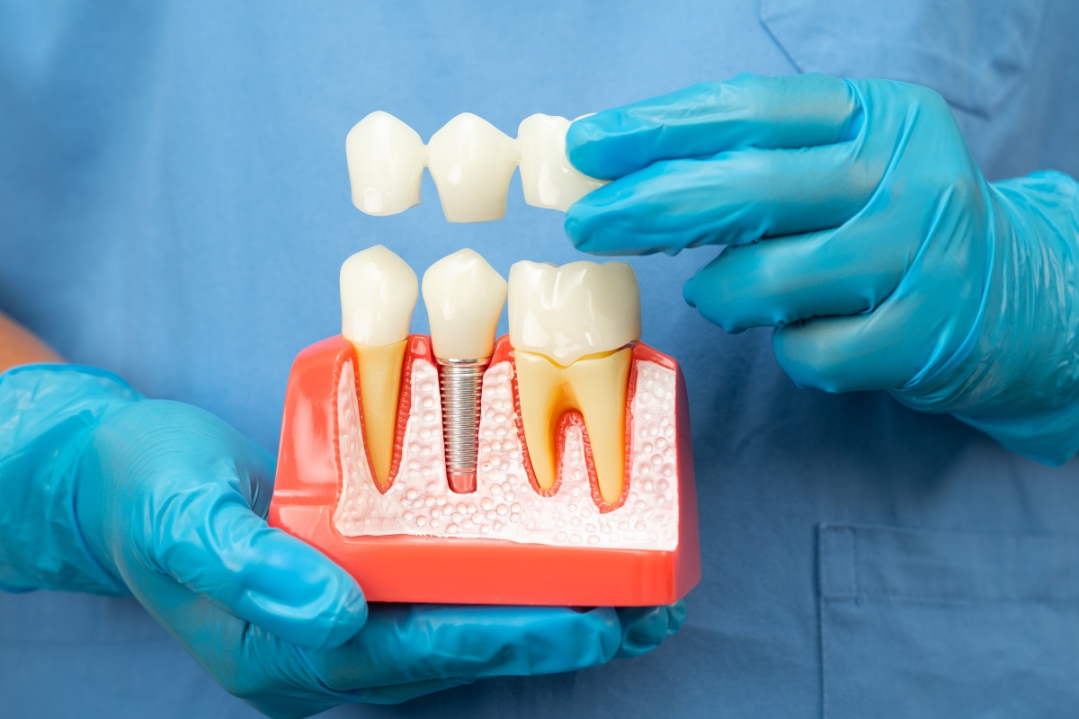 dental implants Irvine