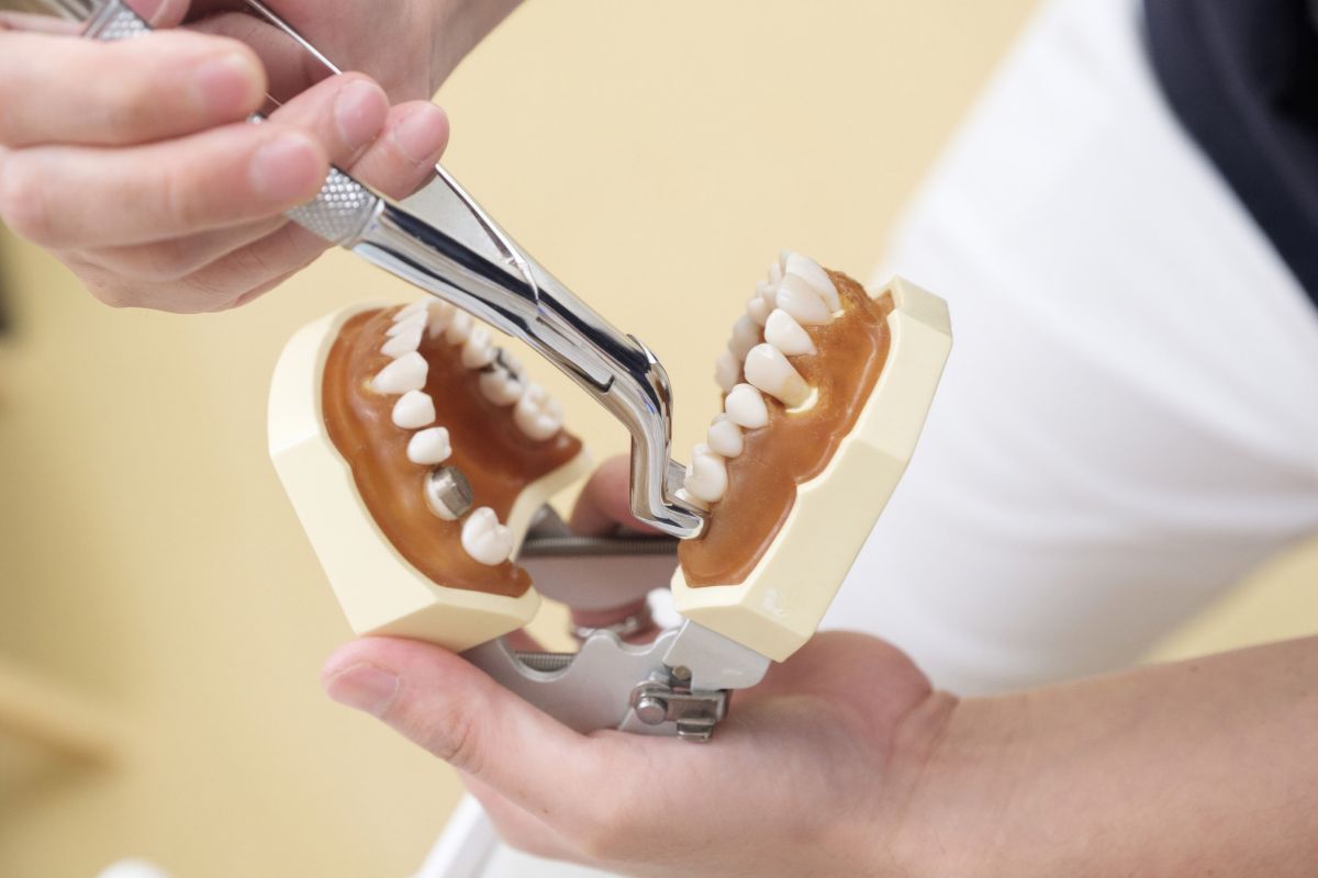 tooth extraction Irvine