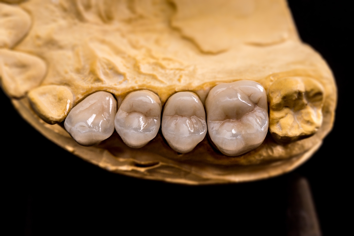 Dental Crowns Irvine