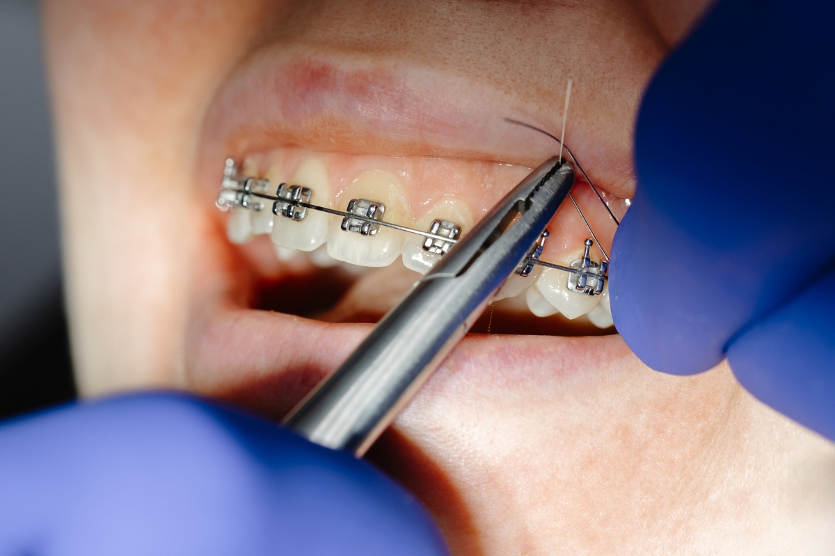 orthodontic treatment Irvine