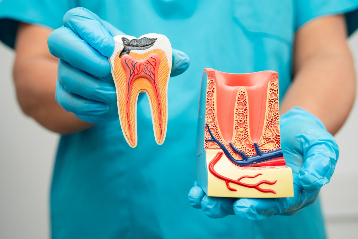 root canal treatment in Irvine