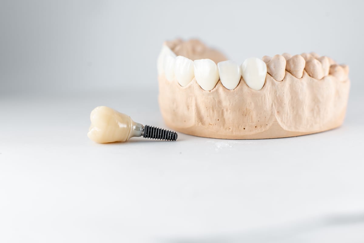 Dental Implants in Oak Creek
