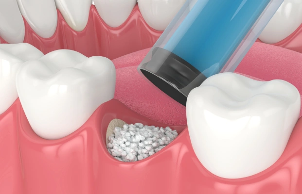 Dental bone graft procedure illustration with graft material filling the jawbone area near teeth.