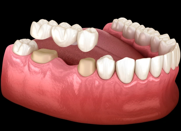 A dental bridge being fitted onto a model jaw to show restorative work at restorative dentistry Alpharetta.
