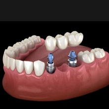 3D illustration showing two dental implants placed in the jawbone for tooth replacement.
