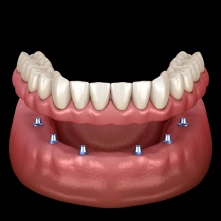 Full lower denture prosthetic displayed on the jaw for functional tooth restoration.