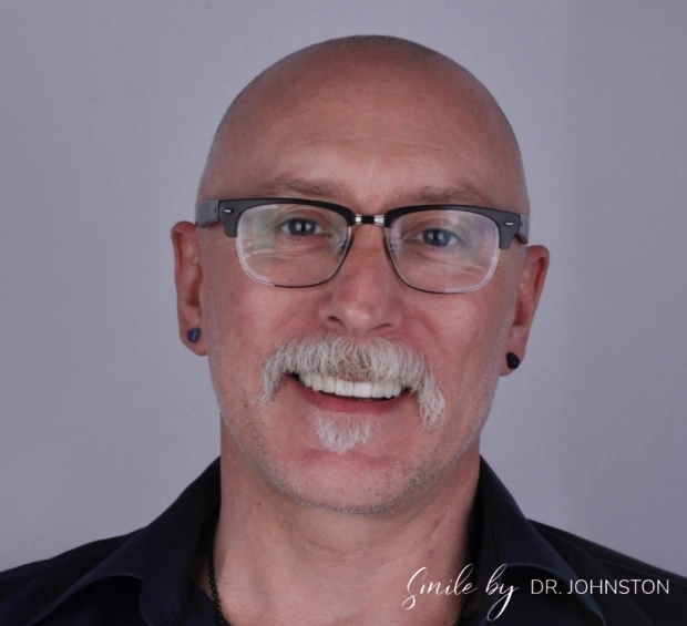dental-veneers