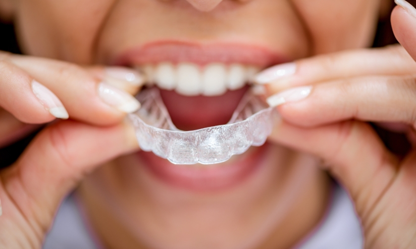 How Do Aligners Help Brides-to-be Get a “Wedding Ready” Smile in 6 Months?