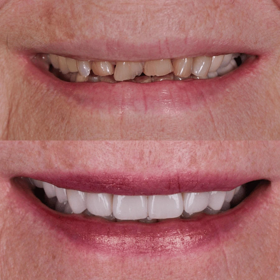 Teeth Cleaning White Center | West Seattle Smile Co.