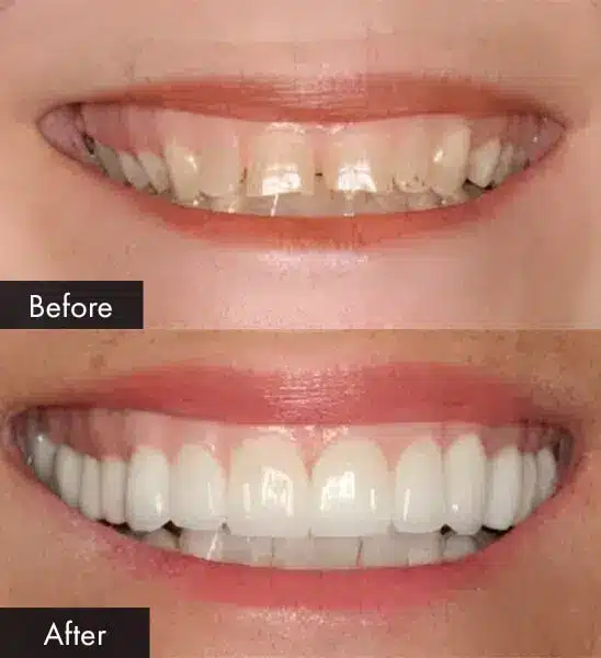 dental crowns in joplin