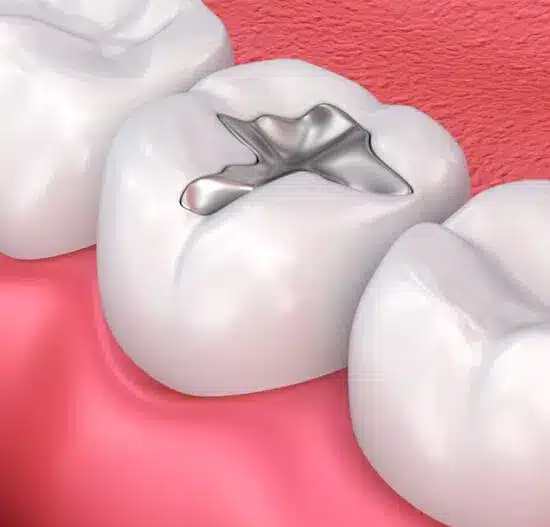 dental fillings in joplin