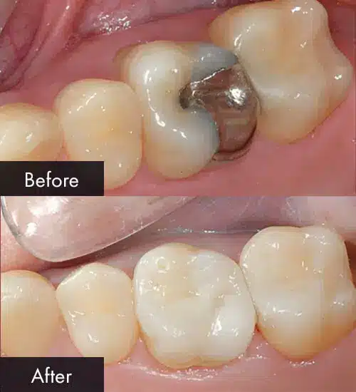 dental porcelain onlays in joplin