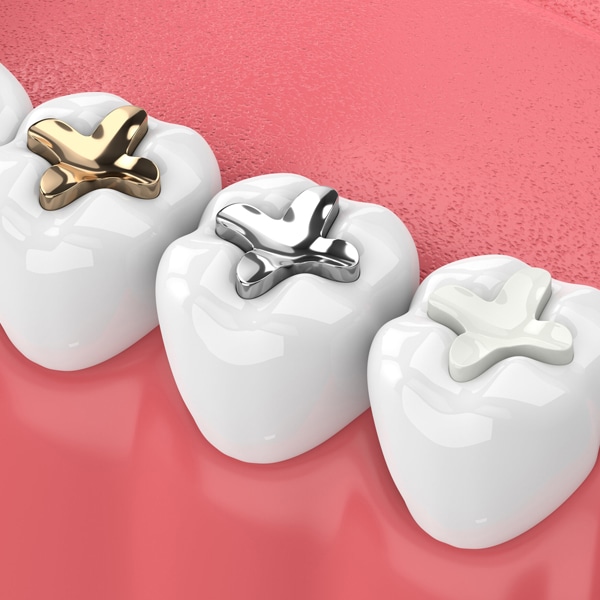 dental fillings in joplin