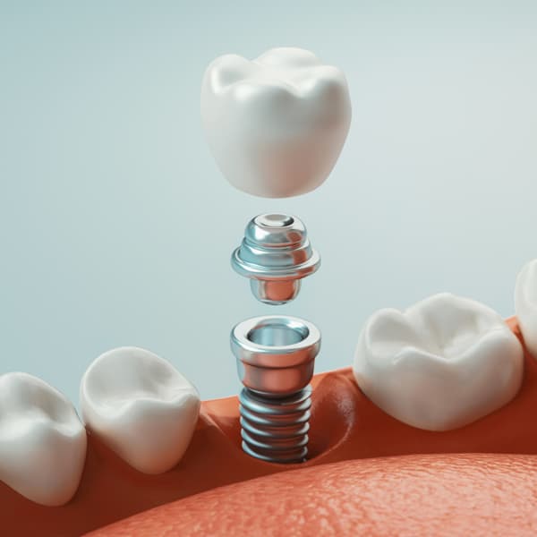 dental fillings in joplin